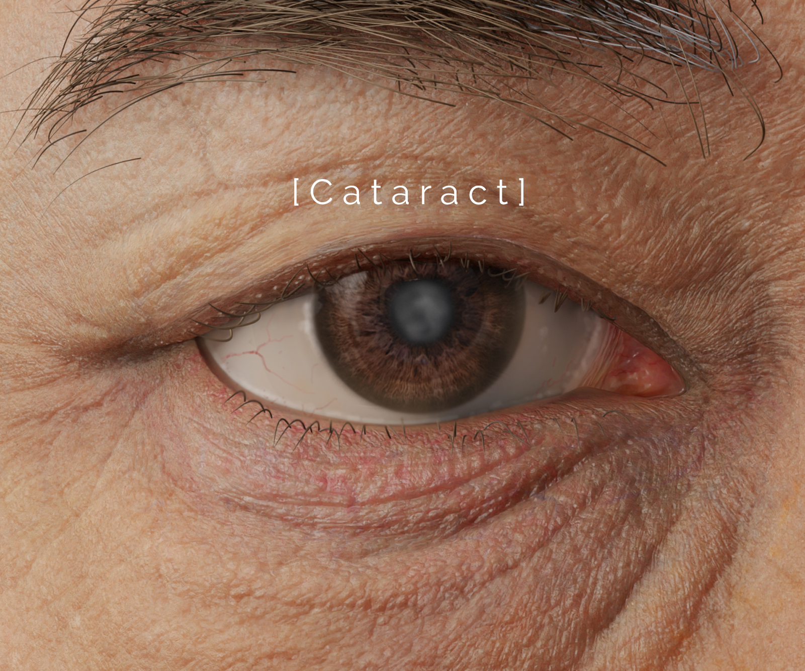 Cataract surgery