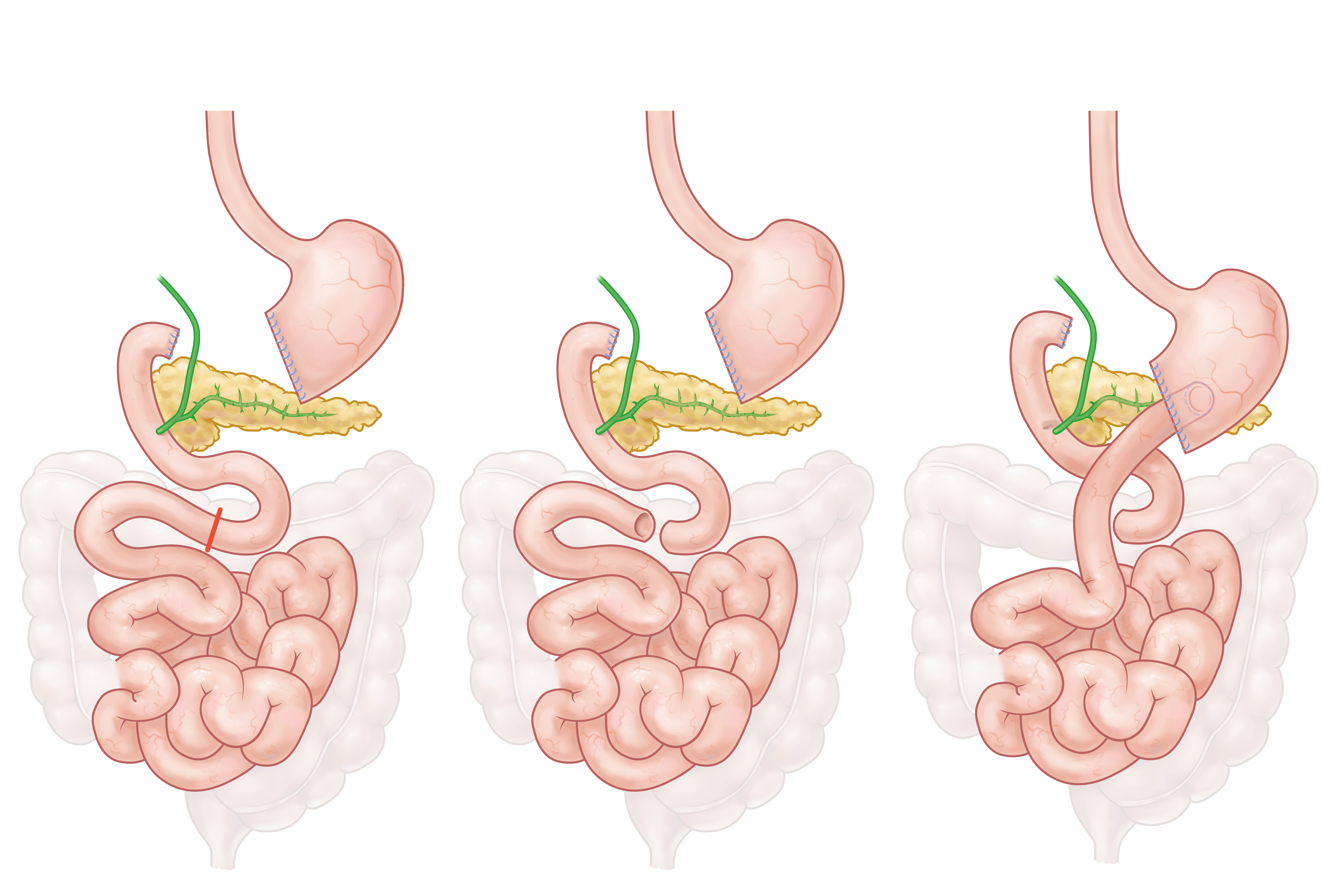 Patient information illustrations